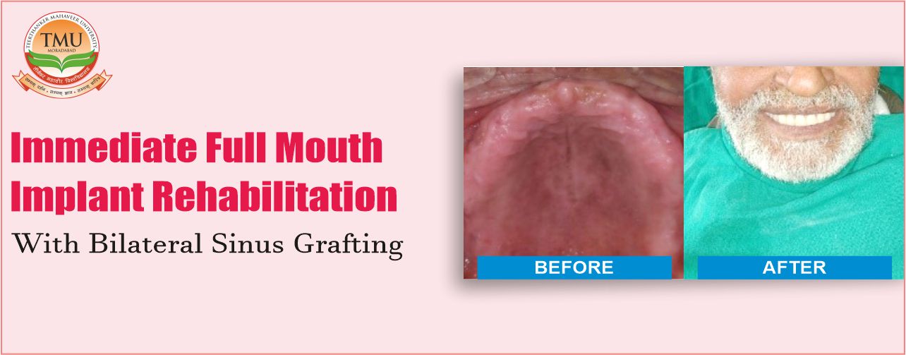 Full Mouth Dental Implants with Bilateral Sinus Grafting
